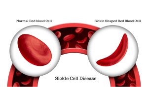 What do you know about Sickle Cell Disease (SCD)?